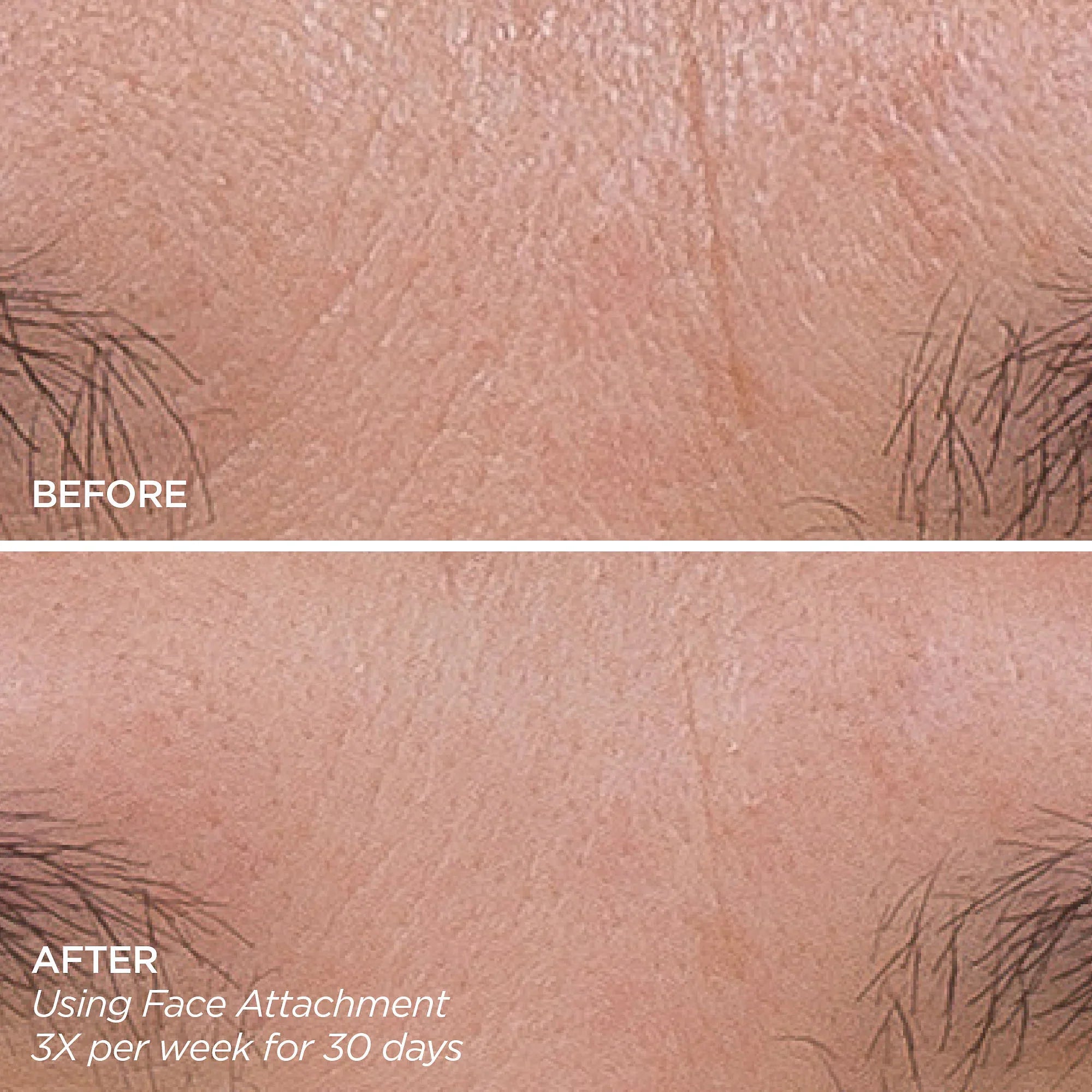 Get That Glow - GloPRO® Microneedling Tool & Discovery Set