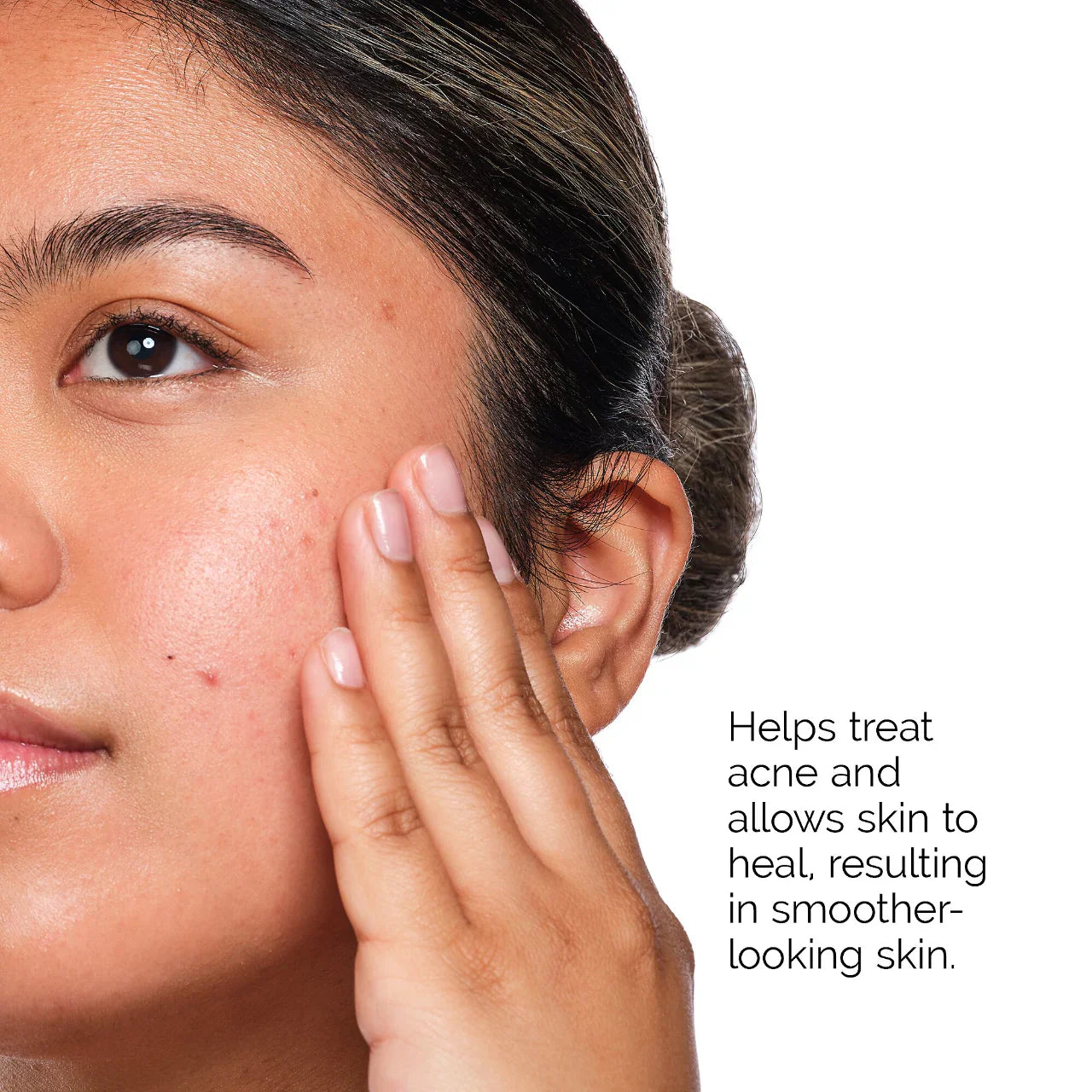 The Acne Set